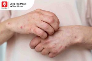 is there a cure for herpes, Medi-Call