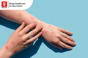 risk of getting infected by monkeypox in bali, Medi-Call