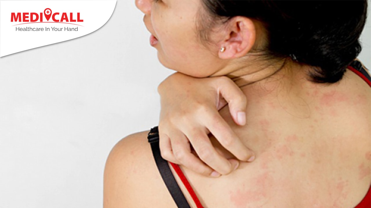 Kenali Penyebab Tubuh Anda Terkena Alergi