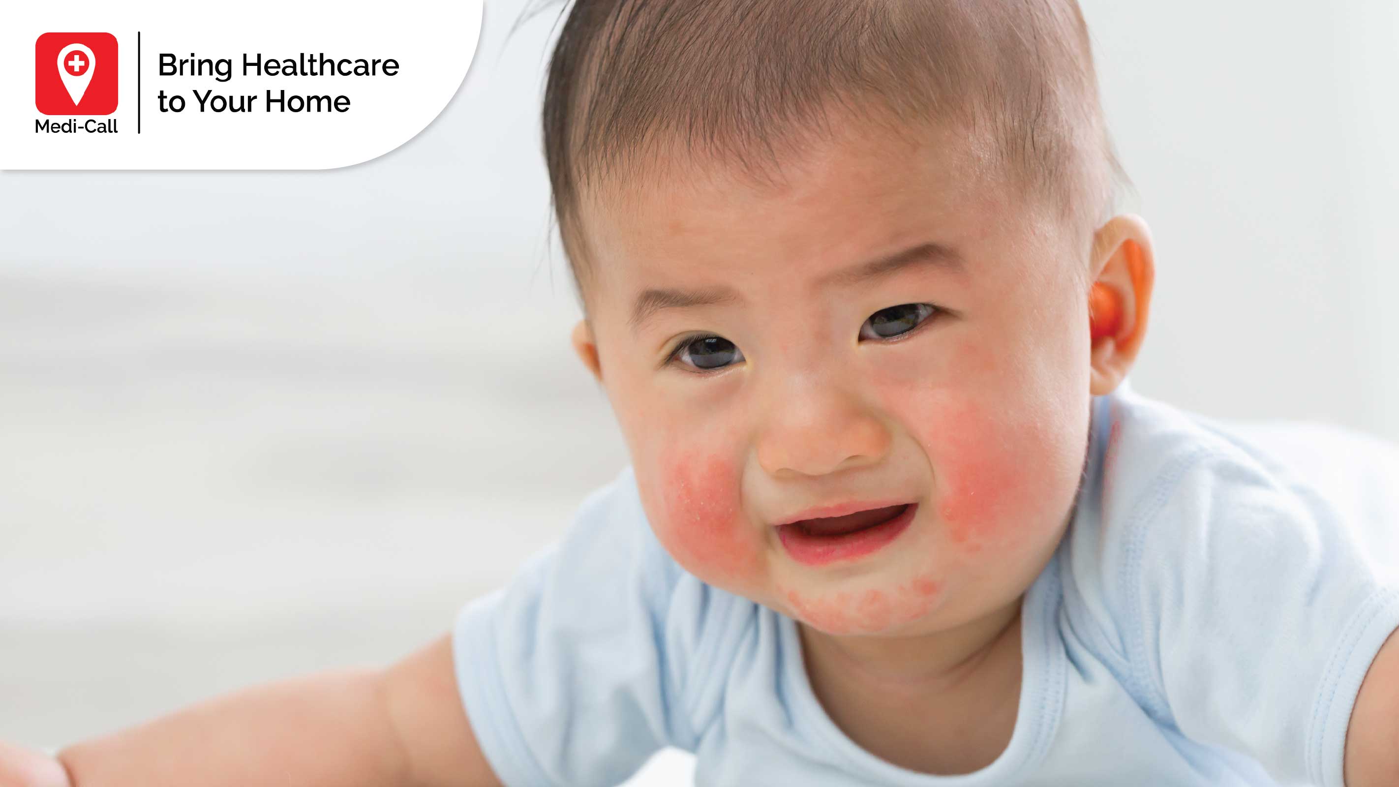 Pahami Ciri, Tanda dan Cara Mengatasi Alergi Kulit pada Anak