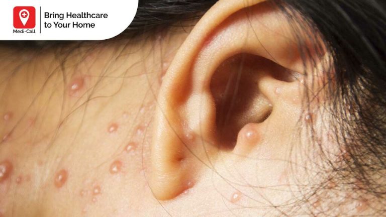 gejala cacar air pada orang dewasa, gejala cacar air, chicken pox, cacar air pada orang dewasa, penyebab cacar air, Medicall, Medi-Call