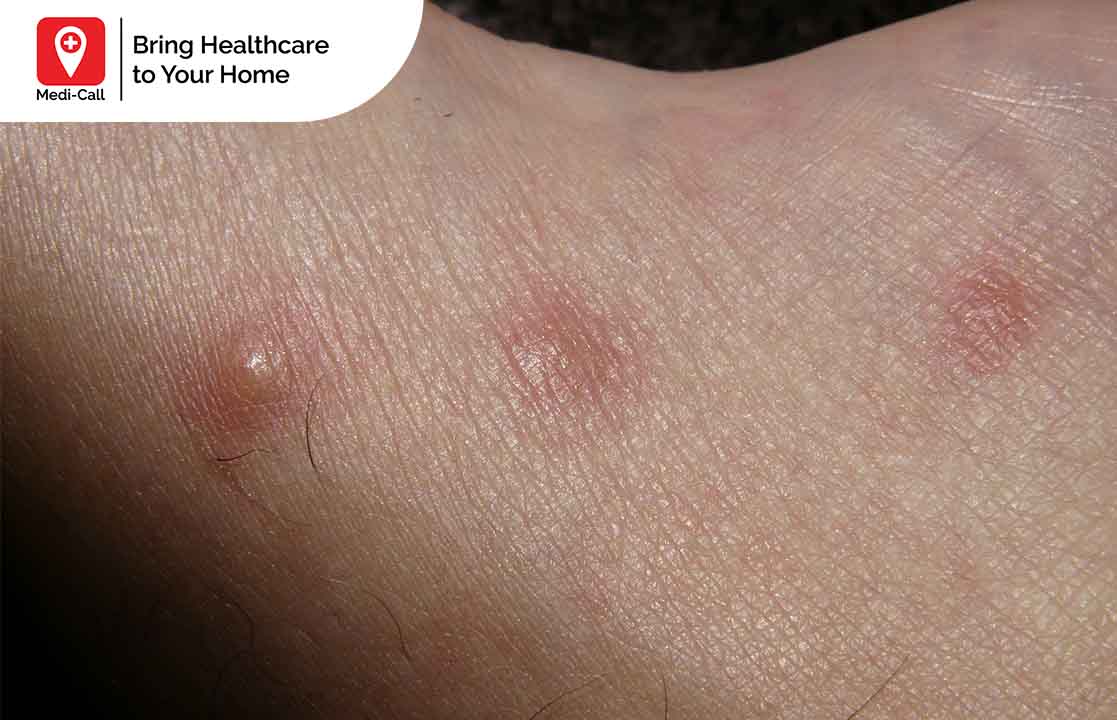 cara mengobati alergi gatal pada kulit, alergi kulut, luka gatal, kulit gatal, bentol, Medicall, Medi-Call