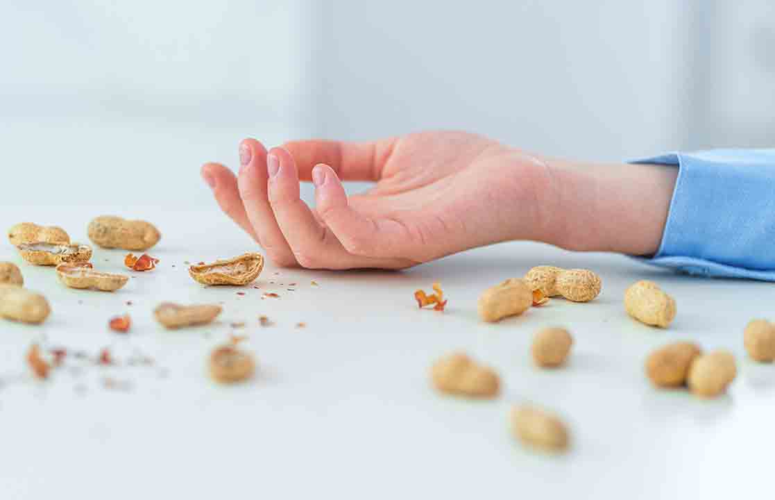 Mengenal Alergi Kacang Tanah: Gejala, Penyebab, dan Cara Mengatasinya