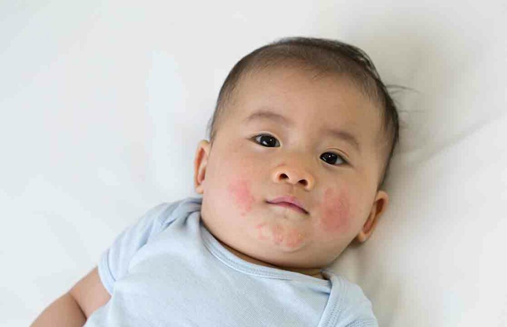 Atasi Biang Keringat pada Bayi Medi-Call