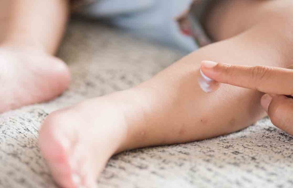 Cara Mengatasi Bisul pada Anak Medi-Call