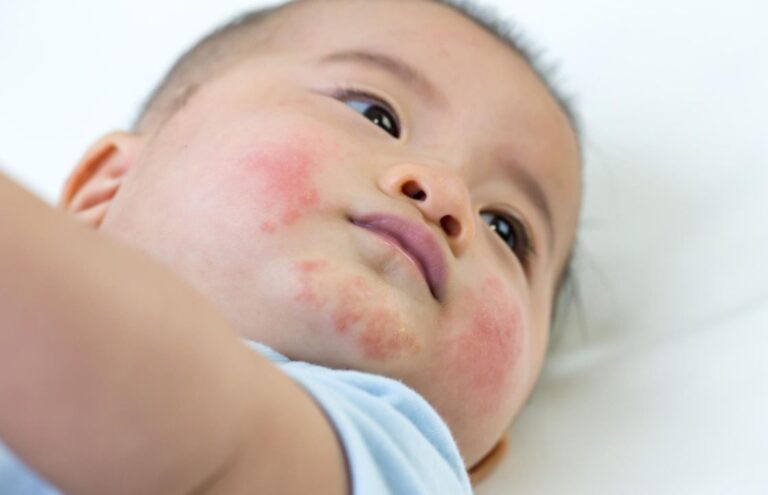 Scabies pada Bayi - Gejala, Penyebab, Obat & Cara Pencegahan Medi-Call