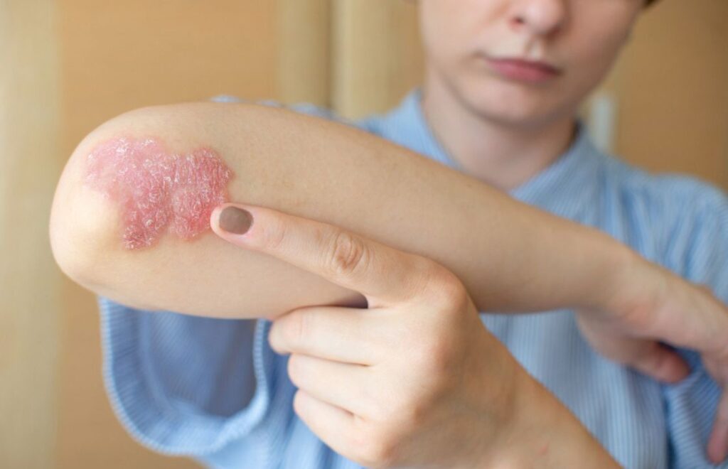 Eksim Kering Penyebab, Gejala, dan Cara Mengatasinya! Medi-Call