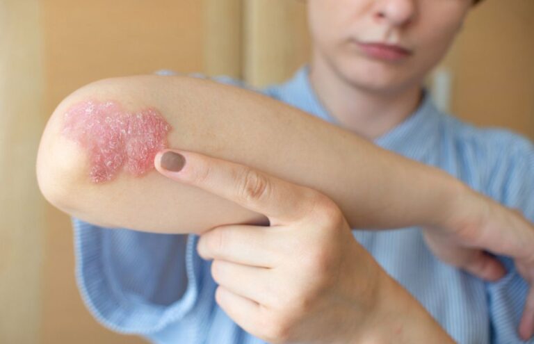 Eksim Kering Penyebab, Gejala, dan Cara Mengatasinya! Medi-Call