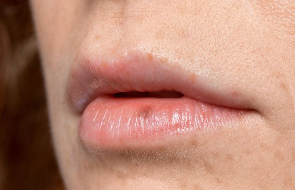 Penyebab Bibir Bengkak dan Cara Cepat Atasi Medi-Call