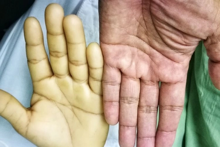 Gejala Anemia