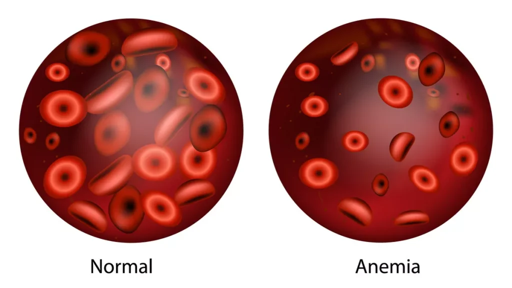 Penyebab Anemia