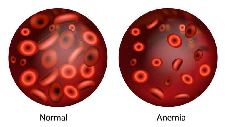 Penyebab Anemia