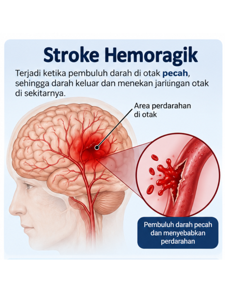 Storke Hemoragik